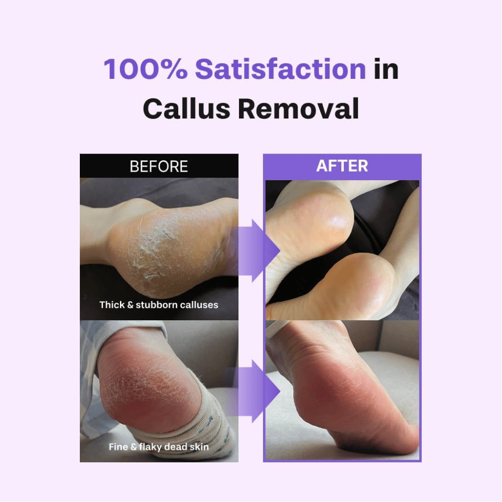 Avant et après l’utilisation de BAREN Foot Callus Eraser Home Set sur les pieds secs, les peaux mortes et les callosités