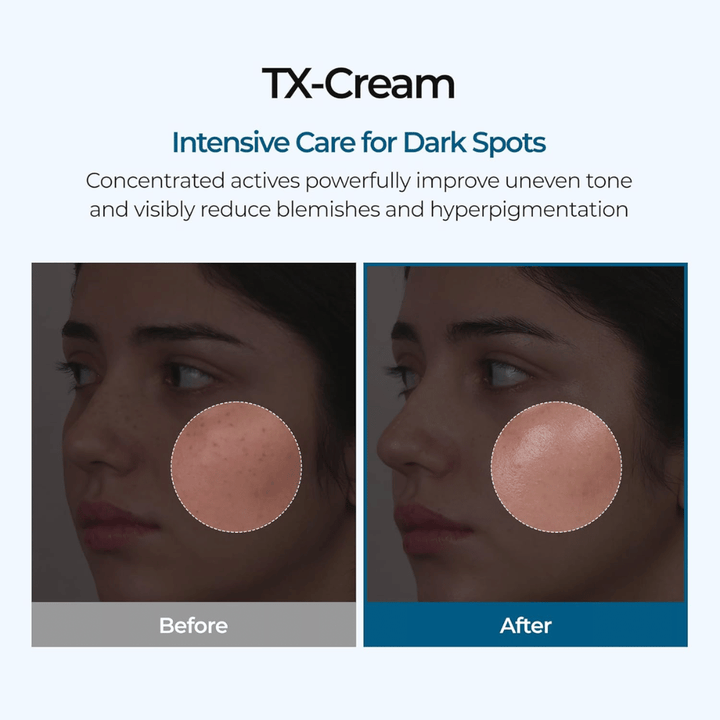 Résultats avant et après avec TX Cream qui réduit les taches brunes et le teint irrégulier pour une peau visiblement plus claire et plus uniforme
